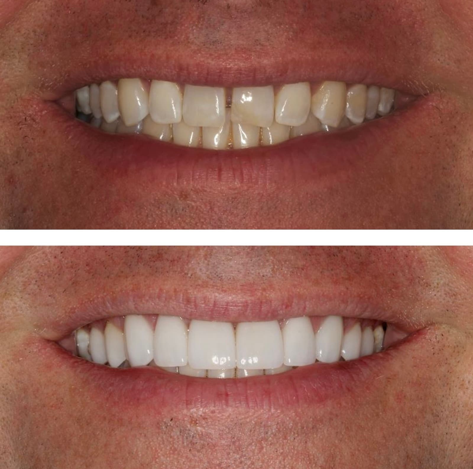 Before and after: ten upper veneers