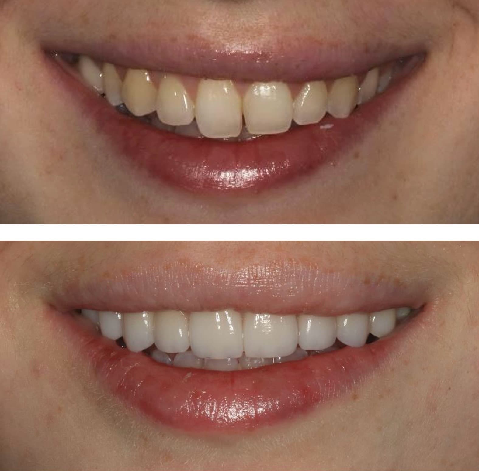 Before and after: ten upper veneers