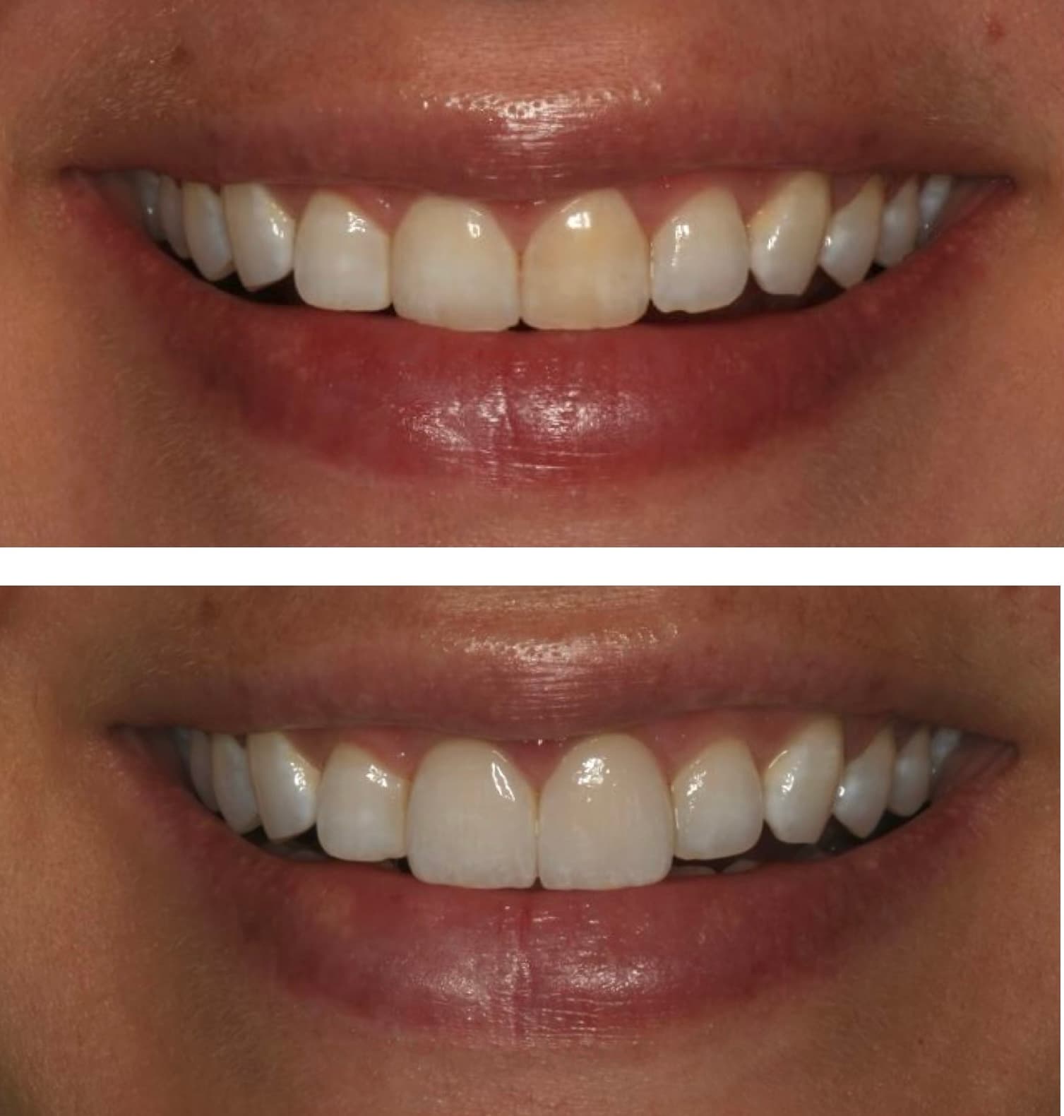 Before and after: veneers on the front two teeth
