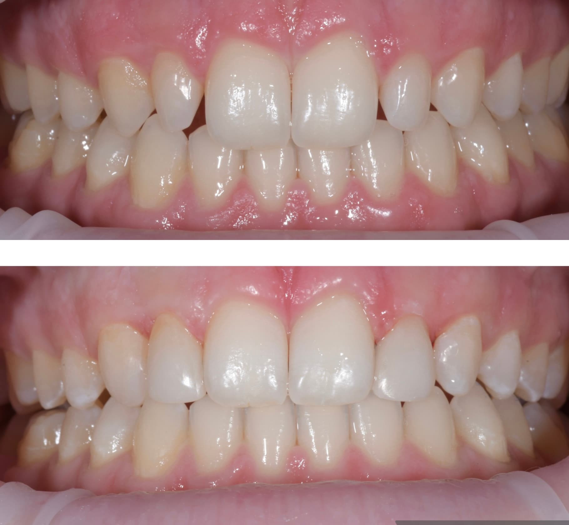 Before and after: cosmetic bonding for peg lateral incisors after braces