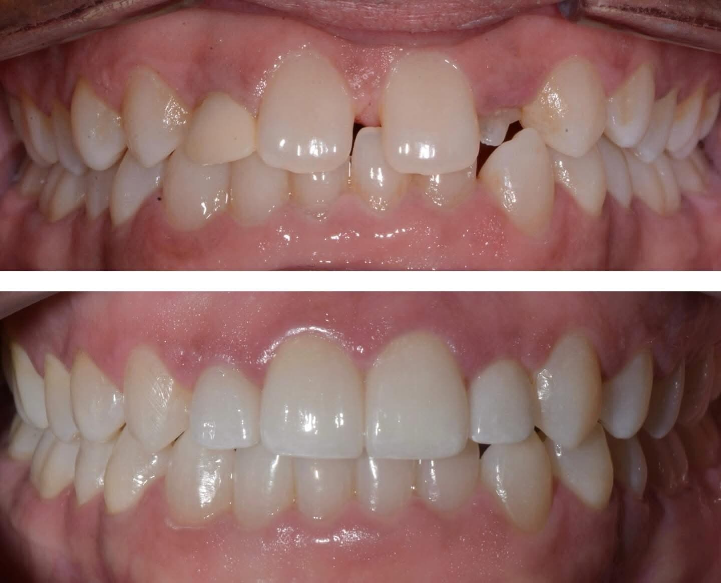 Before and after: four veneers combined with orthodontic treatment