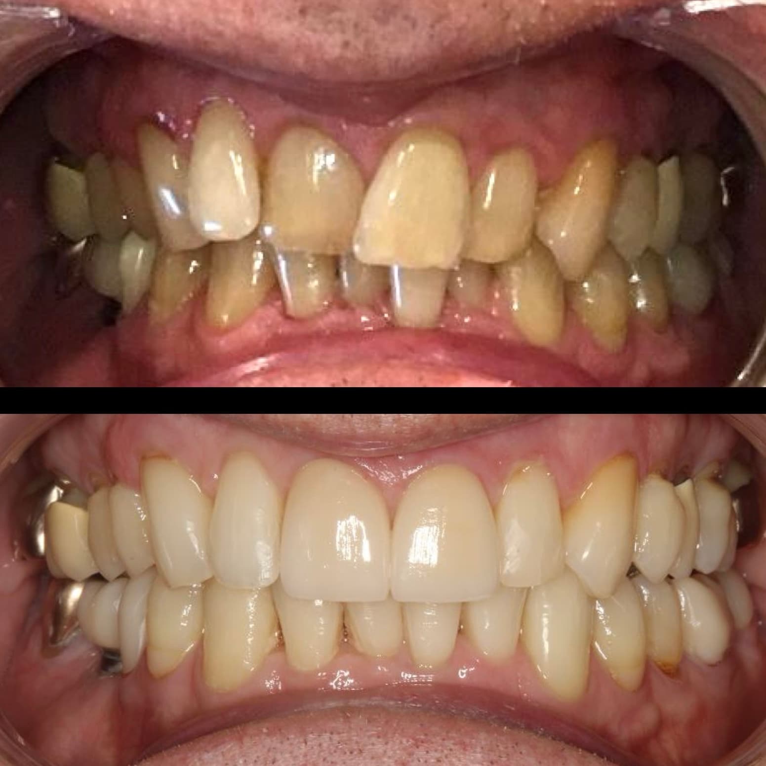 Before and after: whitening and two veneers