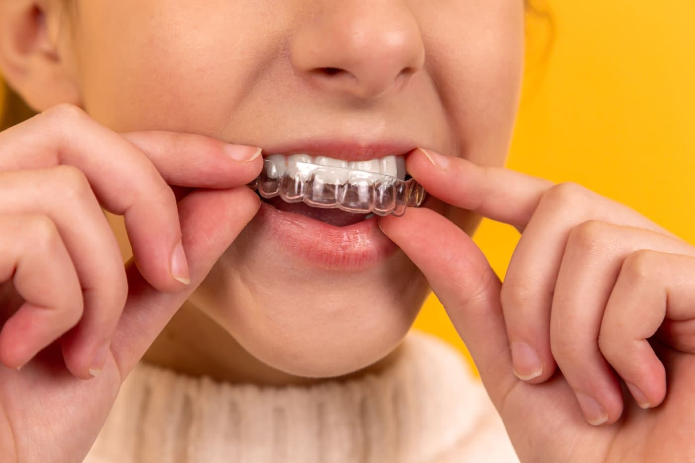 Clear Braces in Decatur GA