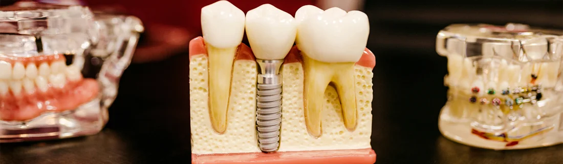FC – Dental Implants At Decatur Family Dental (Decatur, GA) FC – Dental Implants At Decatur Family Dental (Decatur, GA)