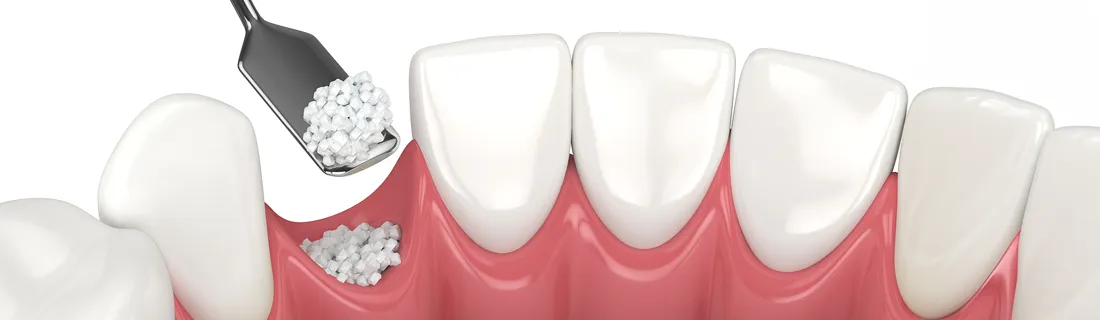 Dentist-Decatur-GA-Bone-Grafting-After-Tooth-Extraction.webp Dentist-Decatur-GA-Bone-Grafting-After-Tooth-Extraction.webp